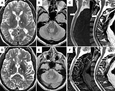 Progressive Demyelination in the Presence of Serum Myelin Oligodendrocyte Glycoprotein-IgG: A Case Report